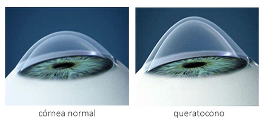 CONOCE QUÉ ES EL QUERATOCONO Y SU TRATAMIENTO